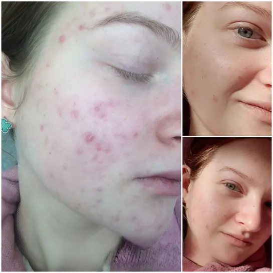 سرم ضد جوش و آکنه نیاسینامید درصد کاز دی باها Cos De BAHA Niacinamide % + %