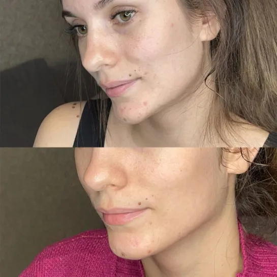 سرم ضد جوش و آکنه نیاسینامید درصد کاز دی باها Cos De BAHA Niacinamide % + %