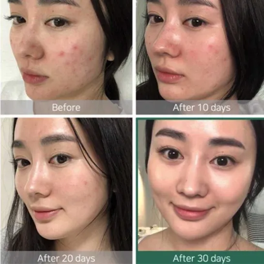 کیت اورژانسی ضد جوش روزه میراکل سام بای می Some By Mi AHA BHA PHA Days Miracle AC SOS Kit