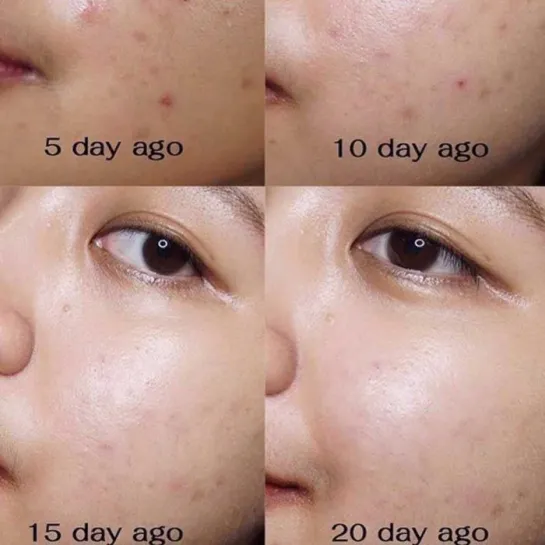کیت اورژانسی ضد جوش روزه میراکل سام بای می Some By Mi AHA BHA PHA Days Miracle AC SOS Kit