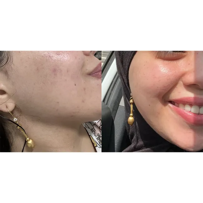 تونر  ضد جوش و آبرسان 30 روزه میراکل سام بای می