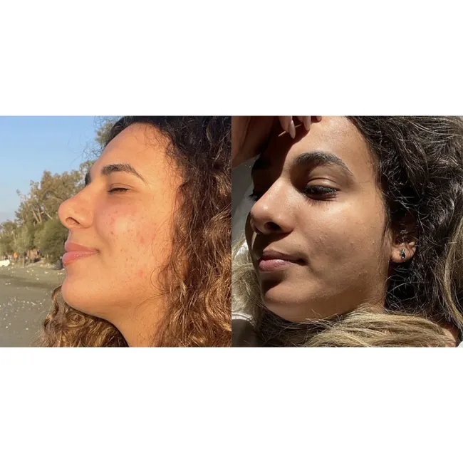 تونر  ضد جوش و آبرسان 30 روزه میراکل سام بای می