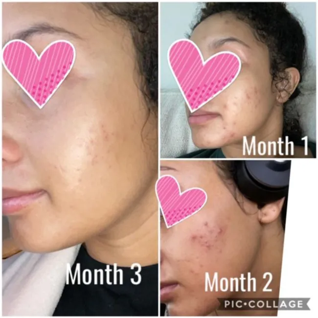 ژل ضد جوش و لایه بردار دیفرین