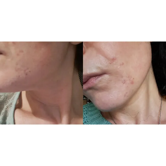 ژل ضد جوش و لایه بردار دیفرین