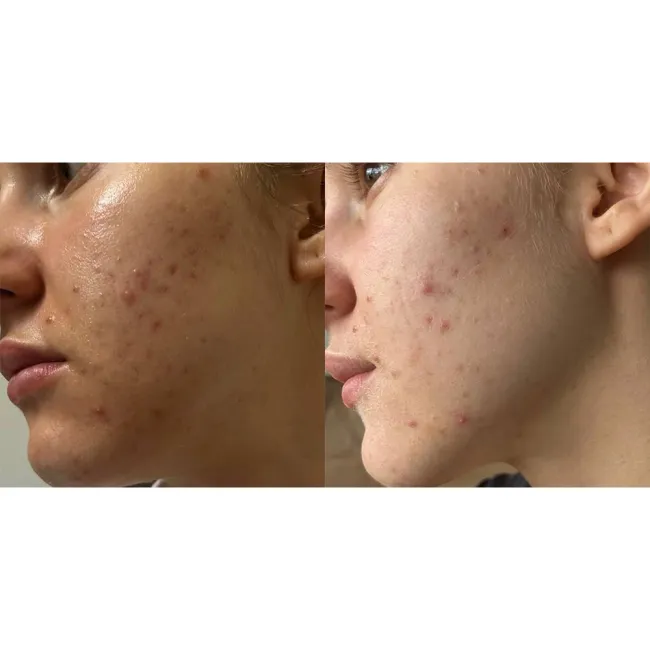 ژل ضد جوش و لایه بردار دیفرین