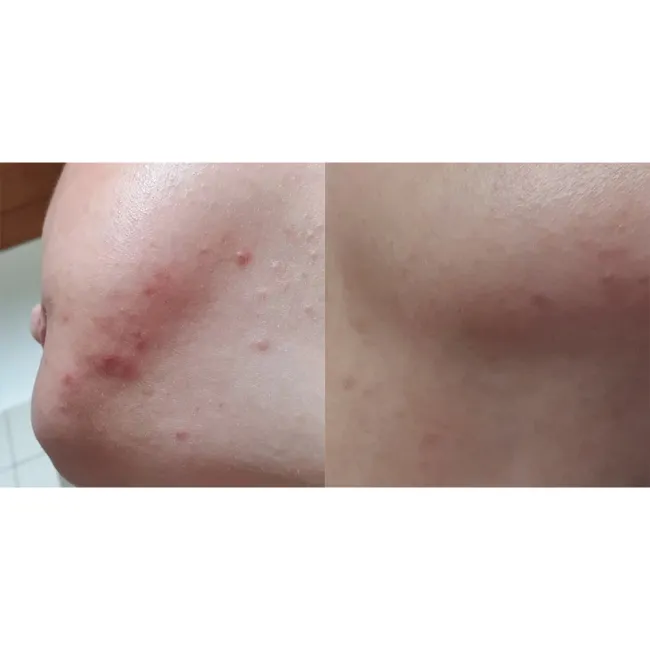 ژل ضد جوش و لایه بردار دیفرین