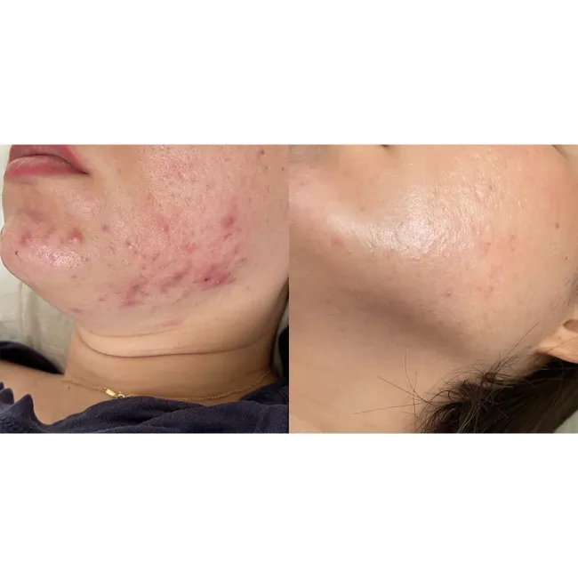 ژل ضد جوش و لایه بردار دیفرین