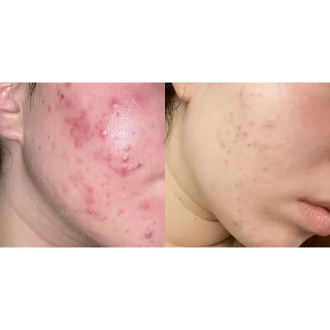 ژل ضد جوش و لایه بردار دیفرین