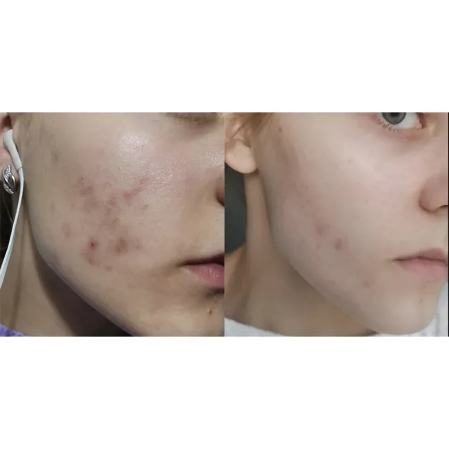 ژل ضد جوش و لایه بردار دیفرین