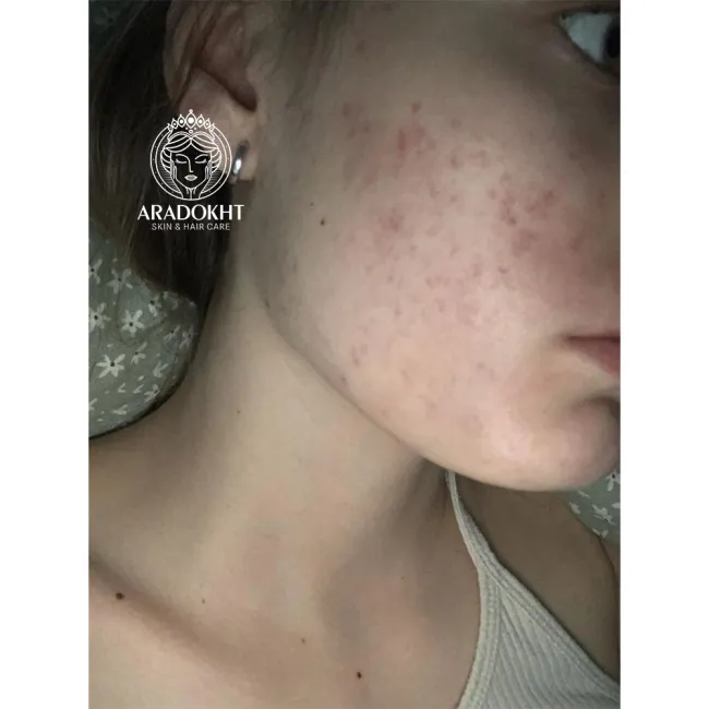 اسنس تقویت کننده و تسکین دهنده ریدل شات 100 وی تی کازمتیک