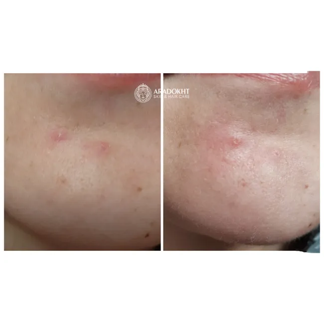 پچ ضد جوش و آکنه میراکل سام بای می