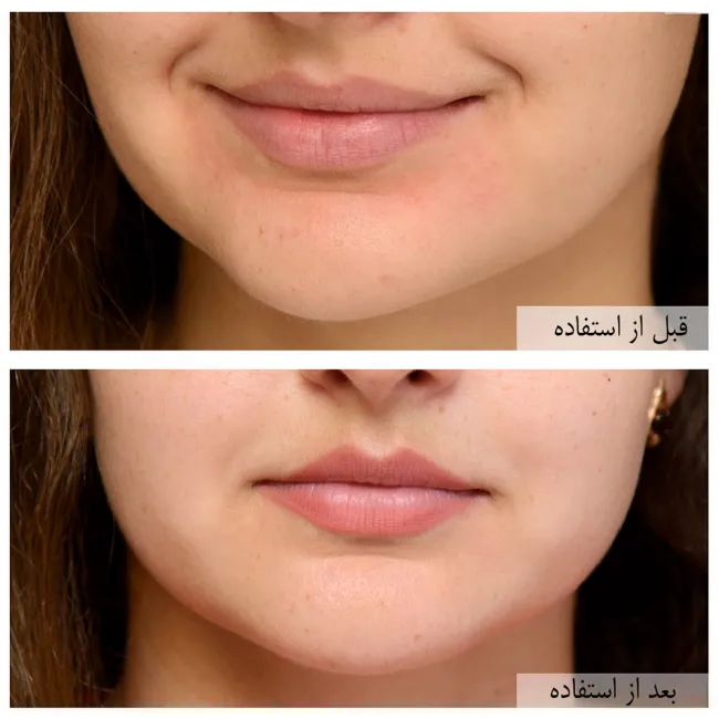 ژل شستشوی نورمادرم ویشی مخصوص پوست چرب و جوش دار