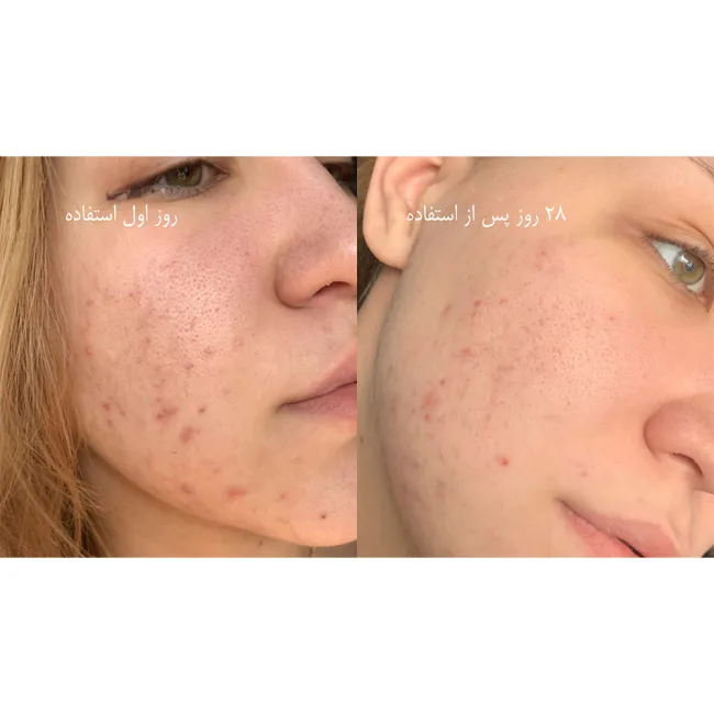 ژل شستشوی نورمادرم ویشی مخصوص پوست چرب و جوش دار