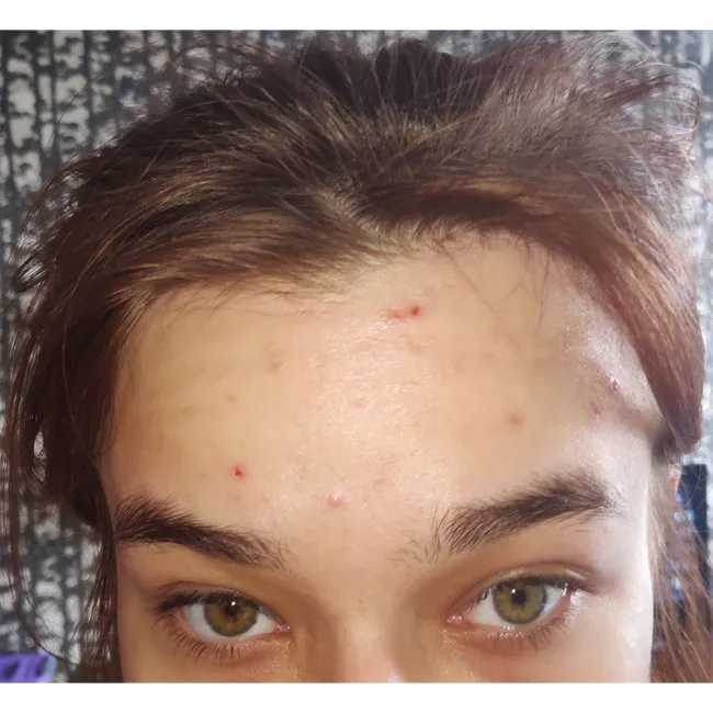 سرم ضد جوش و آبرسان 30 روزه میراکل سام بای می