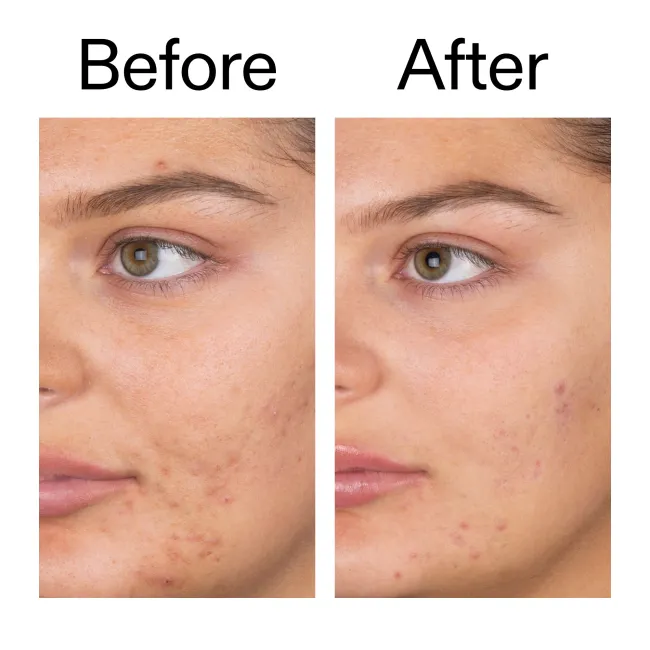 Salicylic Acid Cleanser - 150ml