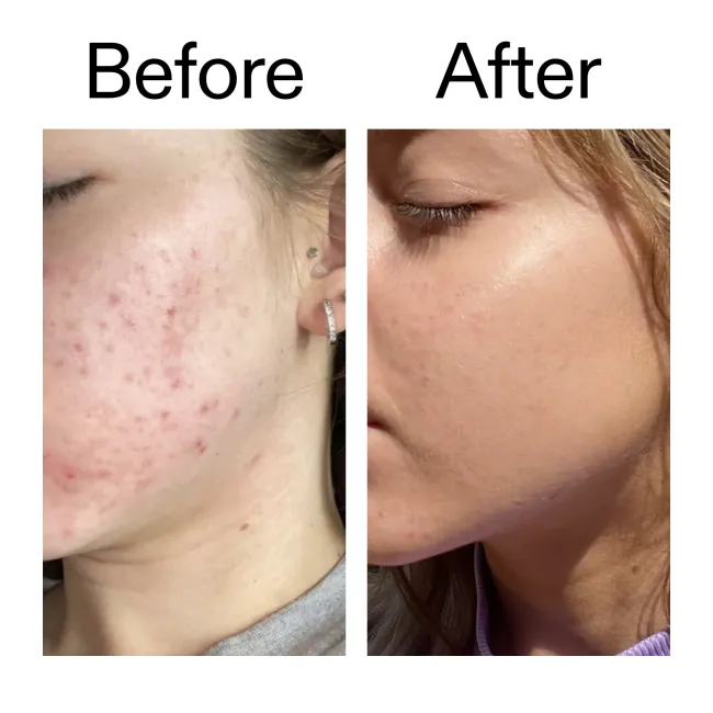 Before and after comparison of a person's face with acne on the left and clear skin on the right.
