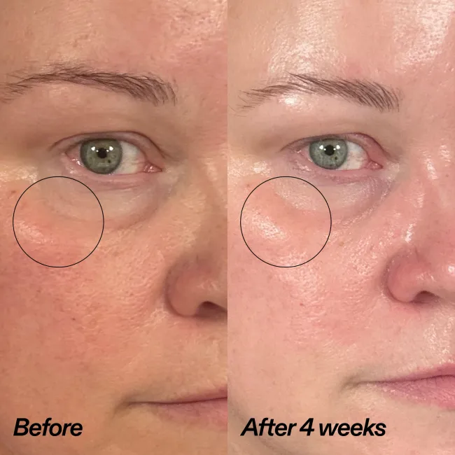 Close-up before-and-after comparison of a person's under-eye area, labeled 'Before' and 'After 4 weeks,' showing a visible reduction in dark circles and puffiness.