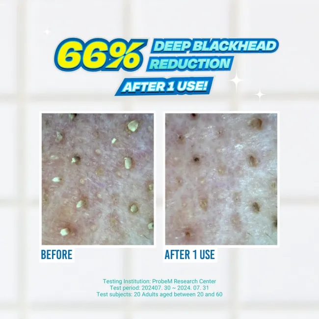 Blackhead Melting Softner Toner 150ml