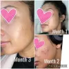 ژل ضد جوش و لایه بردار دیفرین