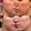 ژل ضد جوش و لایه بردار دیفرین