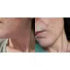 ژل ضد جوش و لایه بردار دیفرین