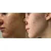 ژل ضد جوش و لایه بردار دیفرین