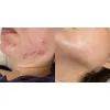 ژل ضد جوش و لایه بردار دیفرین