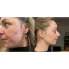 ژل ضد جوش و لایه بردار دیفرین