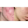 ژل ضد جوش و لایه بردار دیفرین