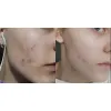 ژل ضد جوش و لایه بردار دیفرین