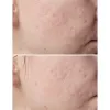 ژل شستشوی صورت ضد لک و جوش سراوی