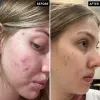 Before and After of Customer using Salicylic Acid Cleanser