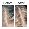 Before and after comparison of someone using Salicylic Acid Exfoliating Scalp Treatment