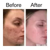 Before and after comparison of a woman's face showing acne improvement. The left 'Before' panel shows visible facial acne on the cheek, and the right 'After' panel shows clearer skin.