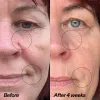 Before-and-after facial comparison of a woman's face, showing skin around the eyes and mouth with circled areas highlighting wrinkles. The left side is labeled 'Before' and the right side is labeled 'After 4 weeks'.