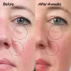 Before and after comparison of a woman's face with circles highlighting areas of improvement.